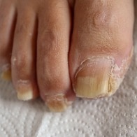 Podiatrist Sydney CBD ingrown toenails