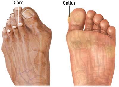 Understanding Corns and Calluses: Causes and Management Strategies