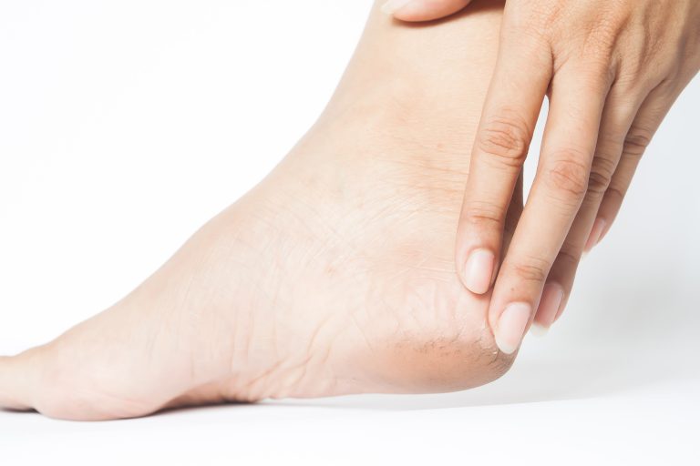 Cracked Heels Solution: Bid Farewell to the Pain and Discomfort